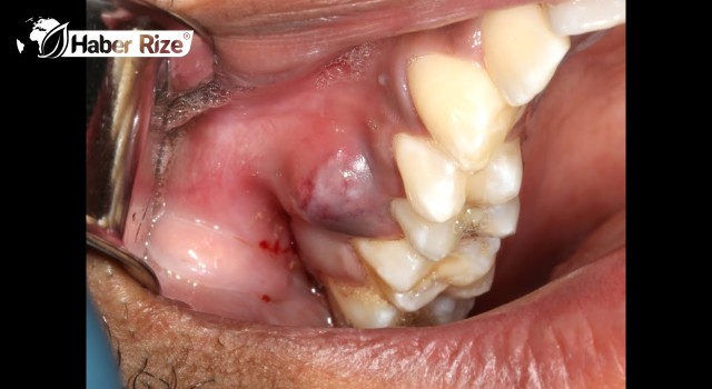 Diş iltihabı ölümcül olabilir